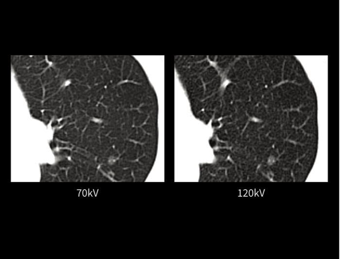 70kV Scan Mode