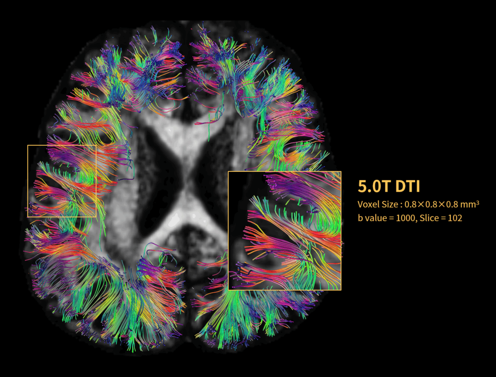 5.0T high-resolution DTI  showing U-fibers 