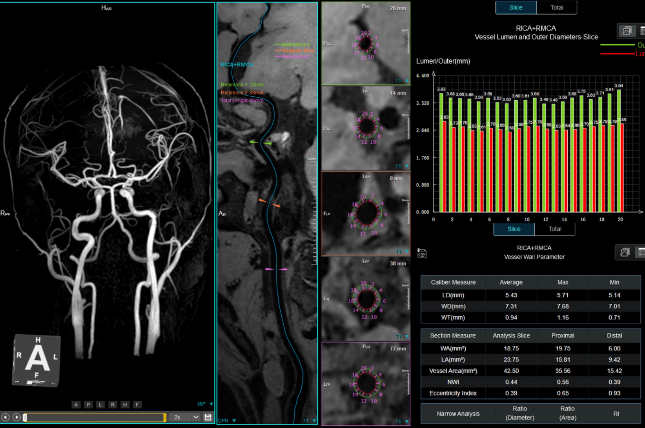 plaque identification and analysis with brain imaging and Vessel Lumen and Outer Diameters-Slice